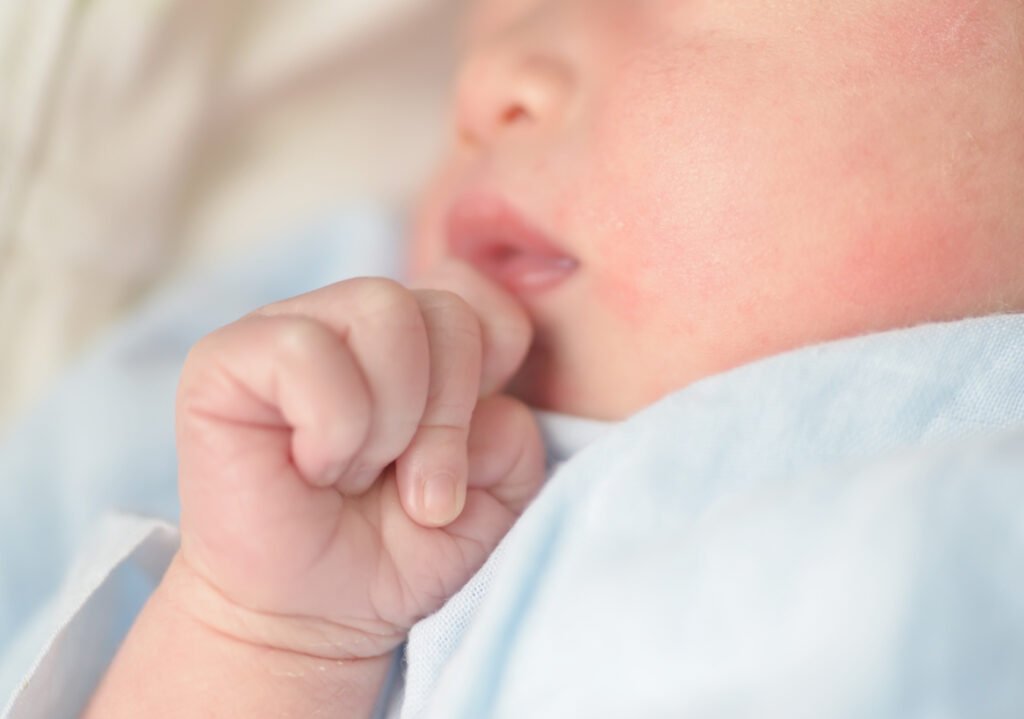 A cute little baby having acne